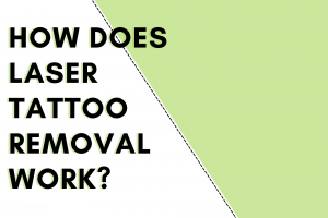 How does laser tattoo removal work article