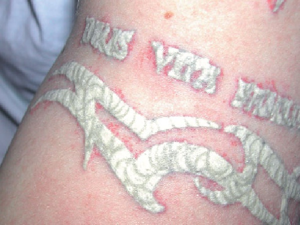 Tattoo Removal Side Effects - Same but worse