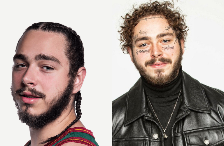 Post Malone Before and After he got his tattoos | Celebrity Tattoo Removal 