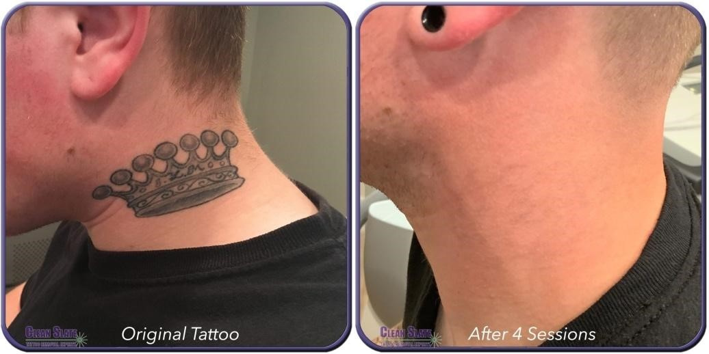 Clean Slate Laser Tattoo Removal Before and After