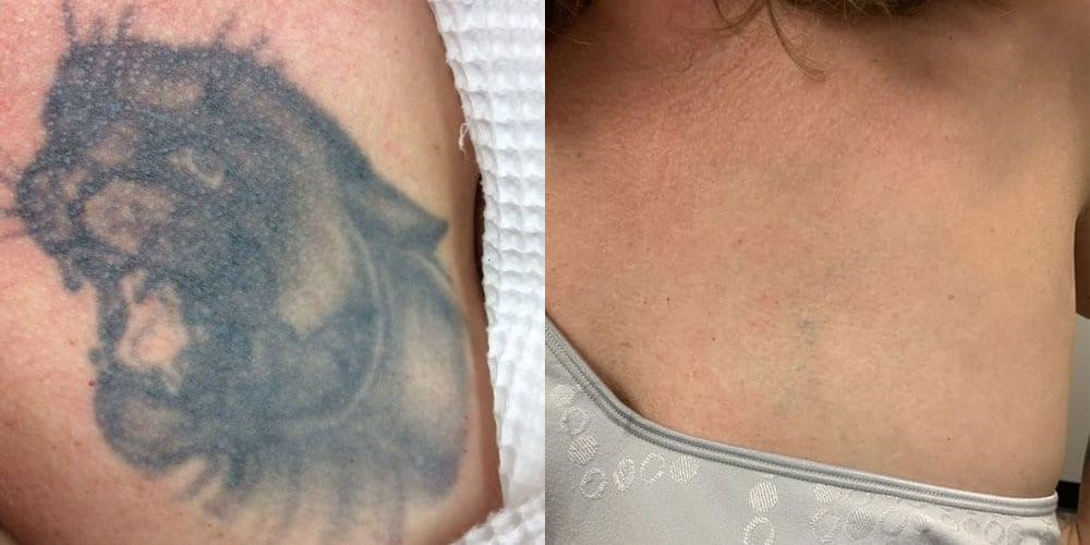 The Finery Tattoo Removal Before and After