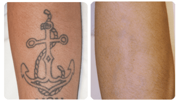 Dr. Renee Patel, Tattoo Removal Before And After
