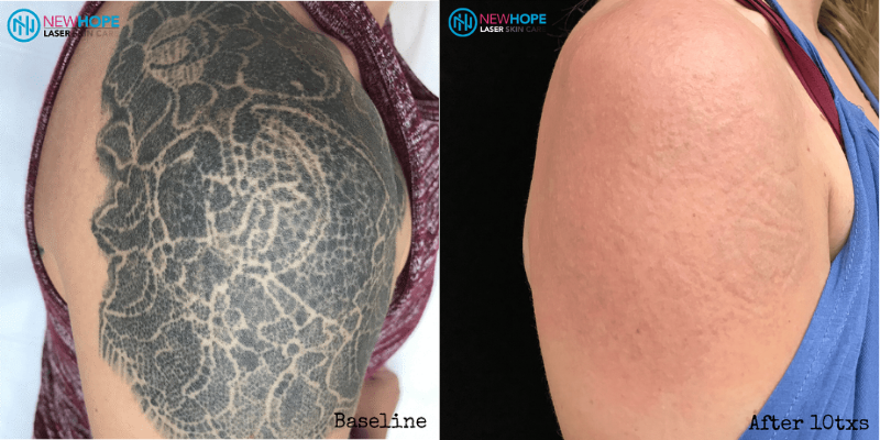 Tattoo Removal Before And After New Hope Laser Skin Care Clinic LA