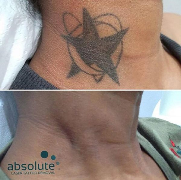 Absolute Laser Tattoo Removal | Before And After | LA