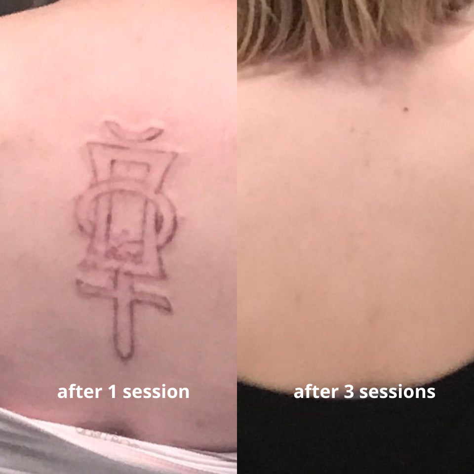 black tattoo removal before and after 