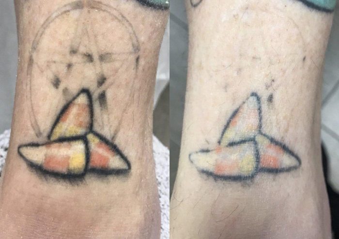 Tattoo Removal Before And After | BelleVie Clinic