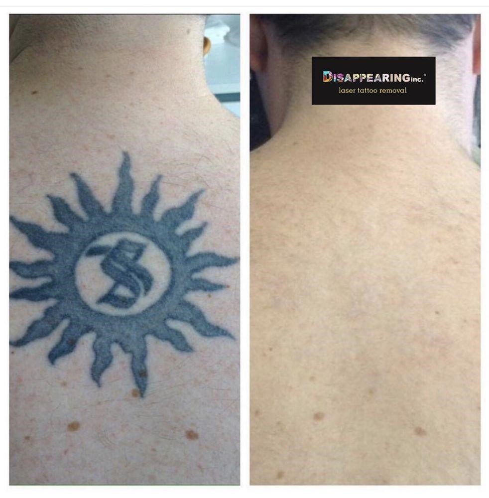 Disappearing Inc Laser Removal Before and After Tattoo