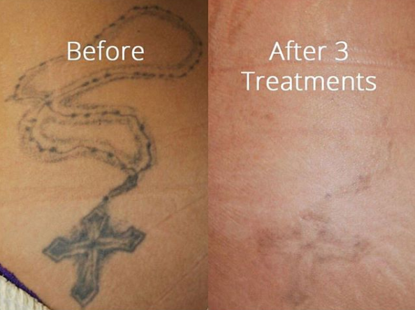 Tattoo Removal Before And After | dr. Laser LA