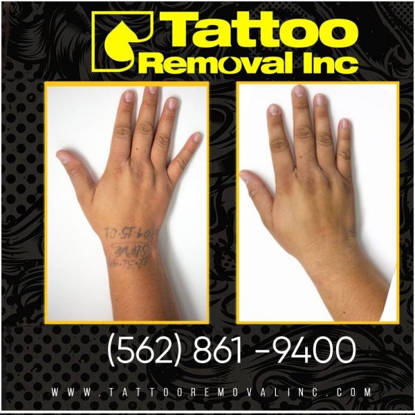 Tattoo Removal Before And After | Tattoo Removal Inc