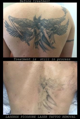 Tattoo Removal Before And After LaserXX LA