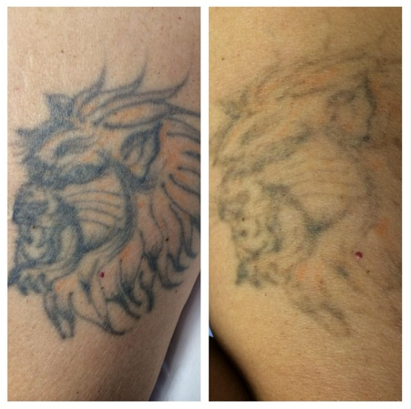 Luminesse Laser Tattoo Removal in Process