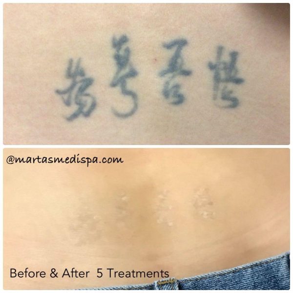 Dr. Marta Recasens' MediSpa, Tattoo Removal Before And After