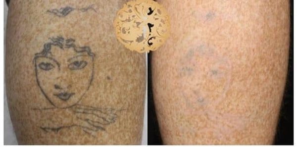 Tattoo Removal Before And After, Los Angeles, Dr. Sheila Nazarian