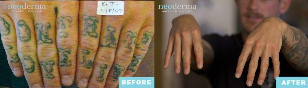 Tattoo Removal Before And After Neoderma LA