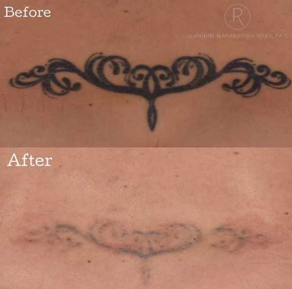 Rejuva Tattoo Removal Before And After