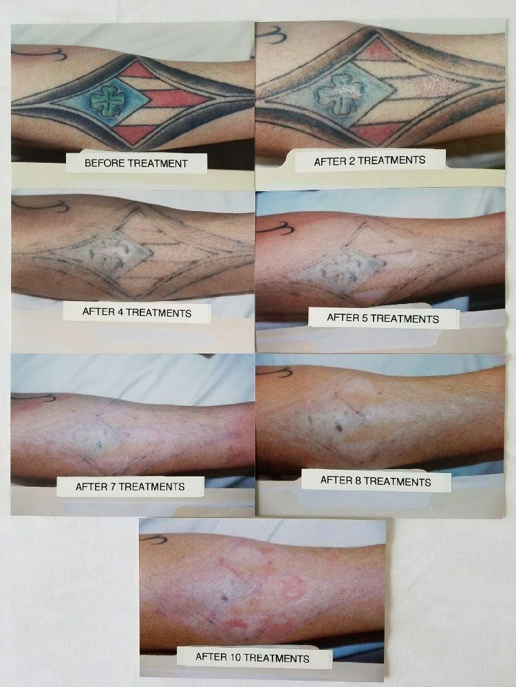 Smooth Clinic Tattoo Removal Before and After