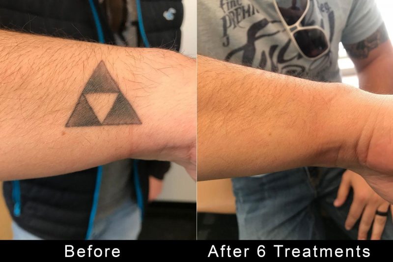 Tattoo Removal Before And After | TattooRemovers.Ink Los Angeles