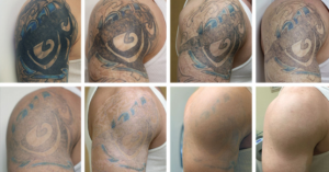 Sugarland laser tattoo removal before and after