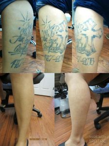Houston tattoo removal clinic tattoo removal before and after