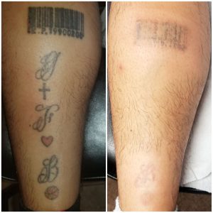Htown Lasers Tattoo Removal Before and after