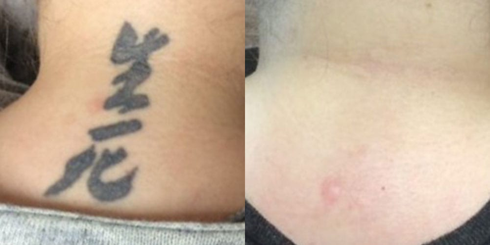 Removery Houston - Tattoo Removal Before And After