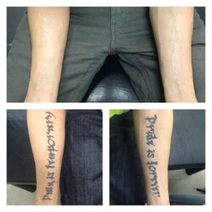Clean Canvas Laser Tattoo Removal before and after