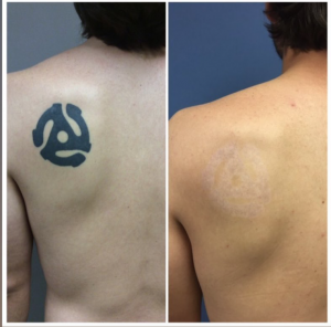 Chicago Breast & Body Aesthetics Tattoo Removal Before And After