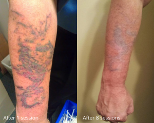 Tattoo Removal Before And After, Hindsight Tattoo Removal, Chicago