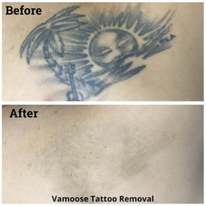 Vamoose Tattoo Removal Before And After Chicago