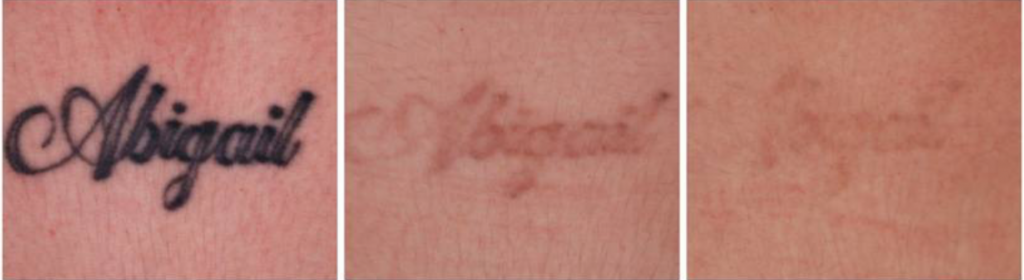 Tattoo Removal Before And After results Enfuse Medical Spa