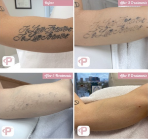 premium tattoo removal - before and after