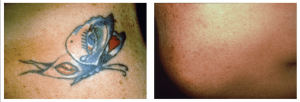 DFW Tattoo Removal Dallas | Tattoo Removal Before & After