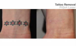 Tattoo removal before and after | REGENCare Spa