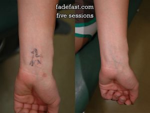 tattoo removal before and after | fade fast laser tattoo removal, dallas