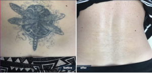 Tattoo removal before and after | Removery