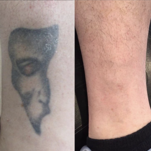 Tattoo removal before and after | Dr. Ink Eraser