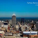 Tattoo Removal Indiana – A Business Guide